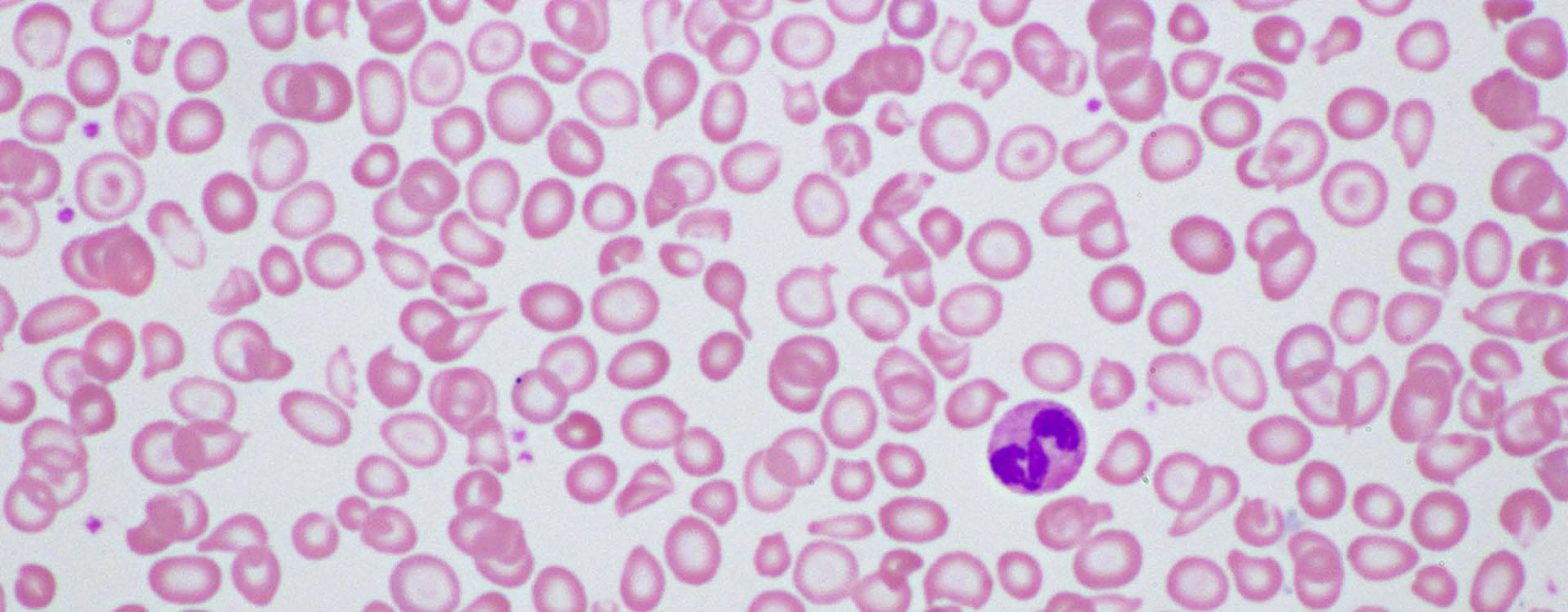Can Cord Blood Cure Thalassemia? Article Image