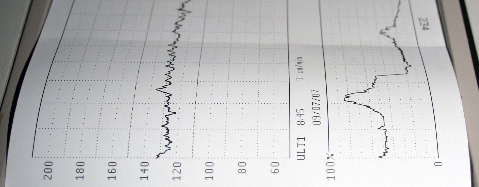 What Do Contractions Look Like on a TOCO Monitor? Article Image