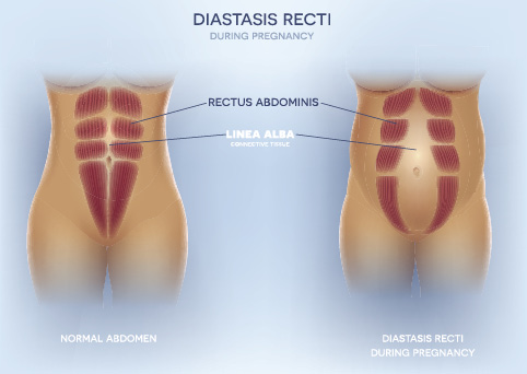 Pregnant with Diastasis Recti, a Hernia and an Active Toddler