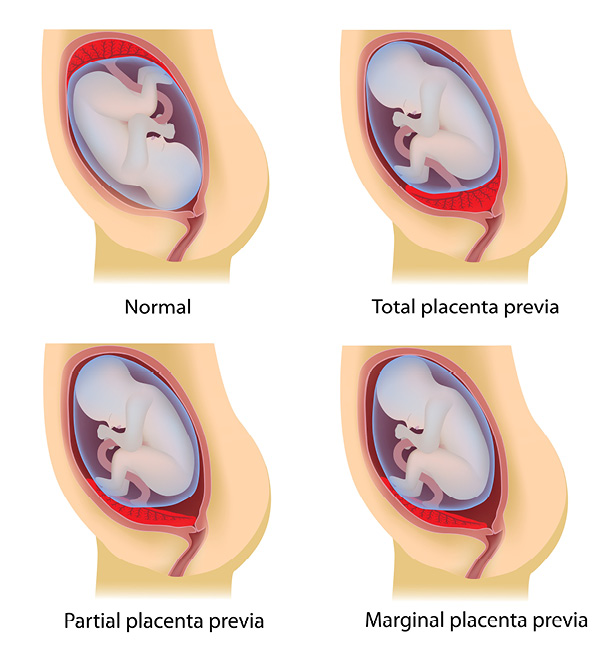 4 types of placenta previa